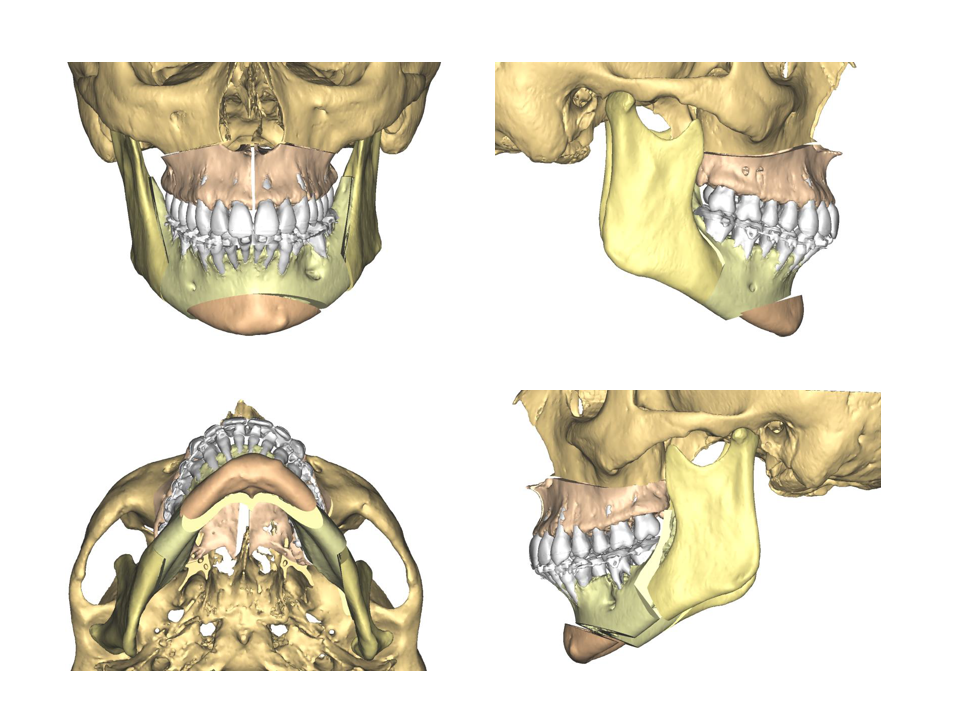 chirurgie orthognathique